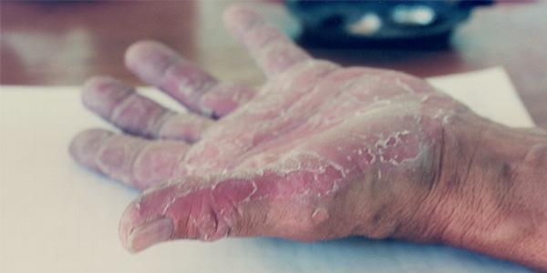 Wits scientists have discovered the genetic mutation responsible for the rare skin disease, keratolytic winter erythema (Oudtshoorn skin) which afflicts Afrikaners