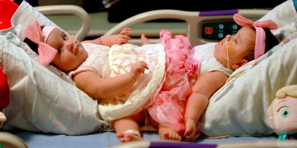 Wits Medical alumnus Dr Haroon Patel (MBBCh 1988) led the surgical team that separated conjoined twin sisters in Corpus Christie, Texas, USA 