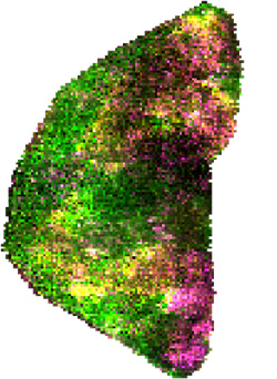 Mass spectrometry imaging showing distribution of small molecular metabolites in a gall bladder core needle biopsy