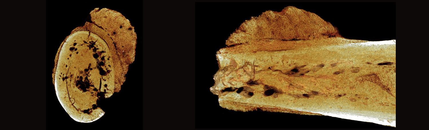 Cancerous growth on Swartkrans foot bone fossil.