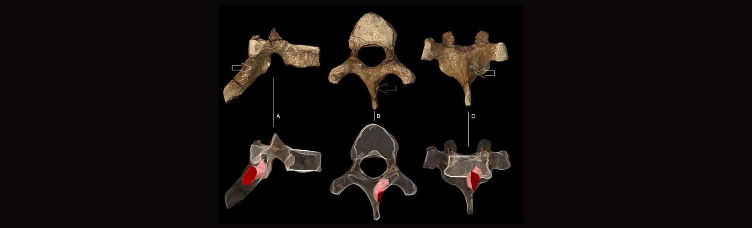 Benign tumour in Sediba vertebra.