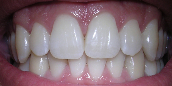 Oral Hygiene Oral Hygiene