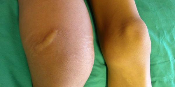 Haemophilia arthropathy.600 x 300 Pic_Prof. Johnny Mahlangu