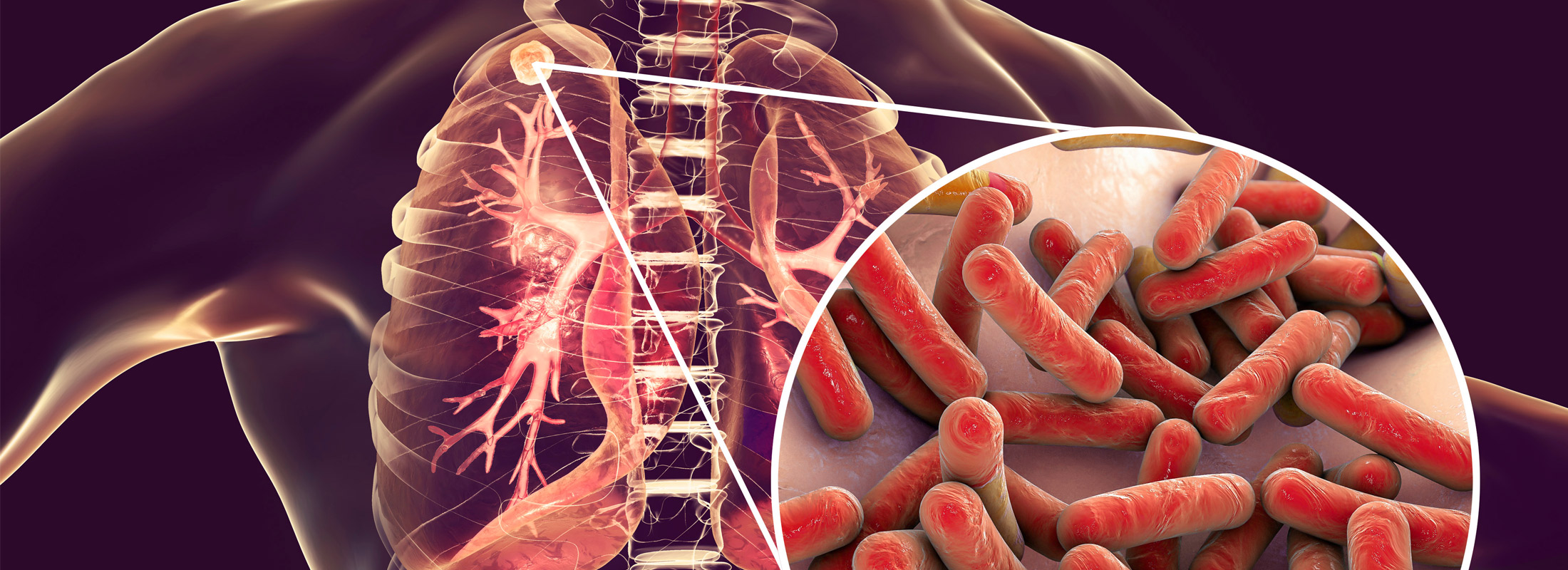 Tuberculosis_TB